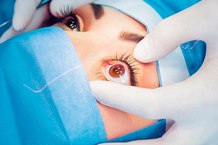 Paciente em campo cirúrgico estéril durante cirurgia refrativa a laser