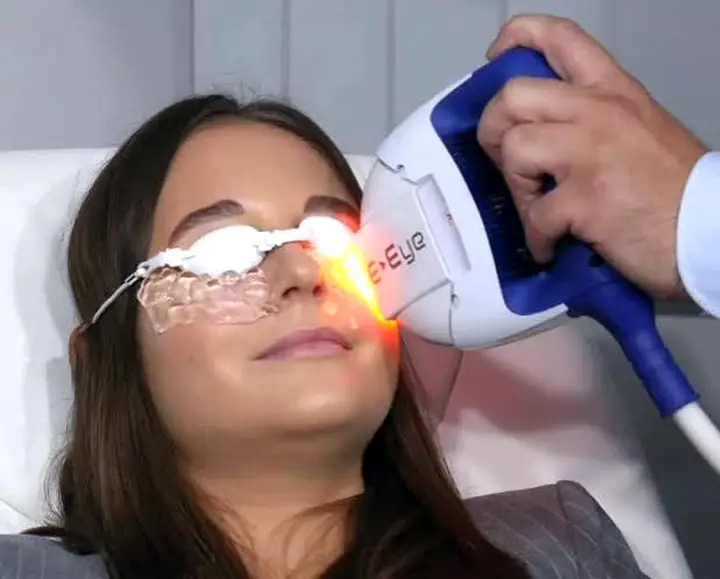 Sessão de luz pulsada (IPL) aplicada na região das pálpebras, com os olhos protegidos